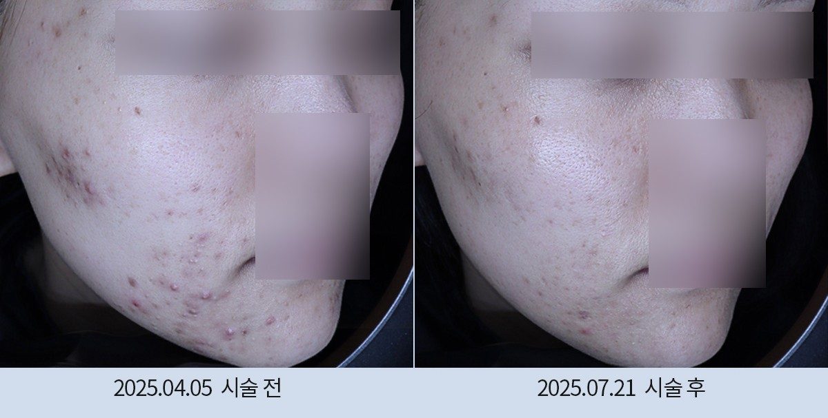 스노우의원 다산점 여드름·붉은기 시술 전후